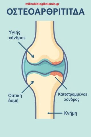 Οστεοαρθρίτιδα : ΟΛΟΚΛΗΡΩΜΕΝΟΣ ΟΔΗΓΟΣ ΓΙΑ ΔΙΑΧΕΙΡΙΣΗ, ΘΕΡΑΠΕΙΑ & ΠΡΟΛΗΨΗ 1 οστεοαρθρίτιδα φλεγμονη θεραπεία