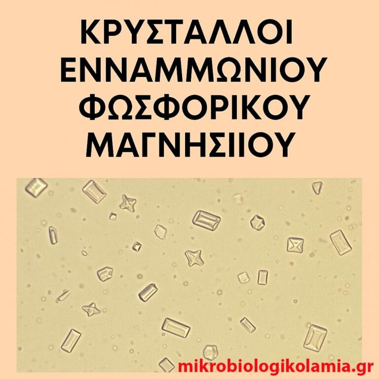 Κρύσταλλοι ενναμμωνίου φωσφορικού μαγνησίου στα ούρα – Αίτια λοίμωξης, συμπτώματα, θεραπεία & πρόληψη